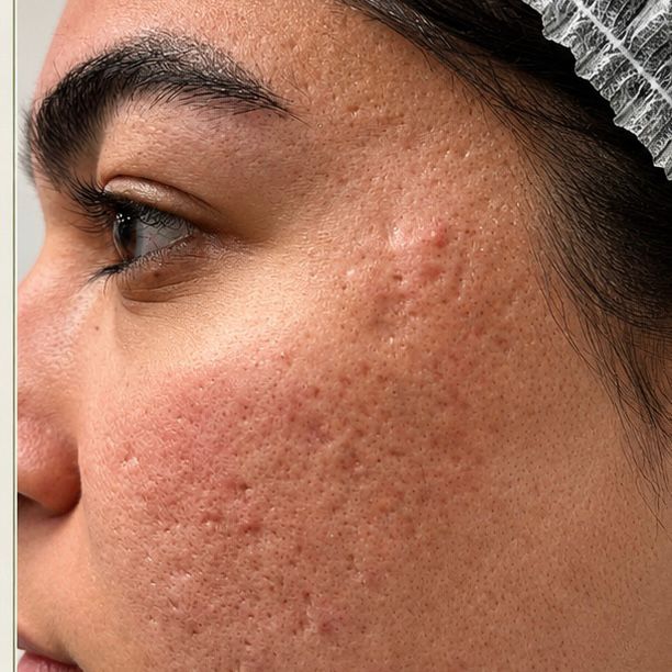 Before Clearer Skin Treatment