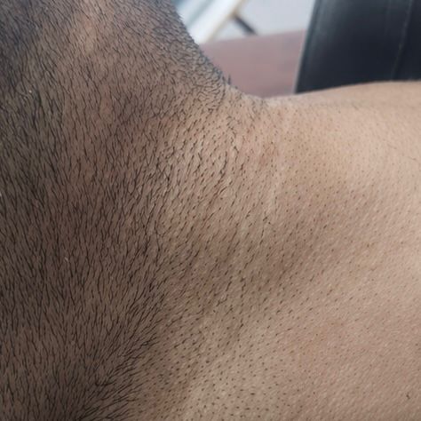 Before Hair Fall Treatment